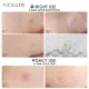 Miếng dán mụn FOCALLURE tái tạo chăm sóc làn da tiện dụng 2g. 