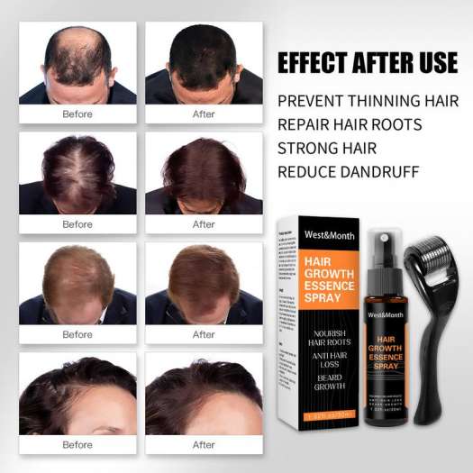 Hair Growth Serum Roller for Hair Growth Longer Healthy Hair Treatment Kit  Anti Hair Loss Serum Treatment for Men Women robust - Chăm sóc tóc chuyên  sâu 