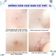 Miếng dán mụn gom cồi sử dụng ngày và đêm bảo vệ mụn kiểm soát dầu giảm sưng đỏ gồm 24 miếng nhiều kích cỡ CN053.00. 